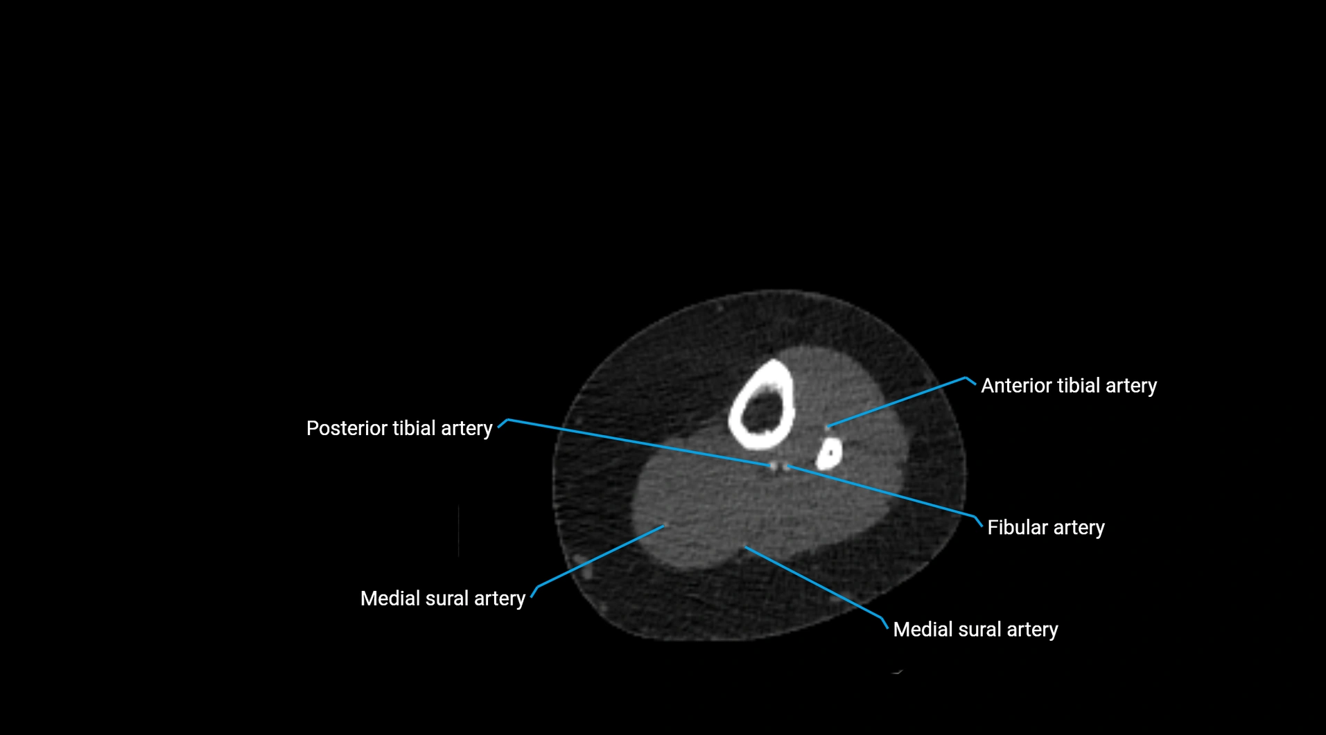 CTA lower limb cross sectional anatomy labelled image _203.webp